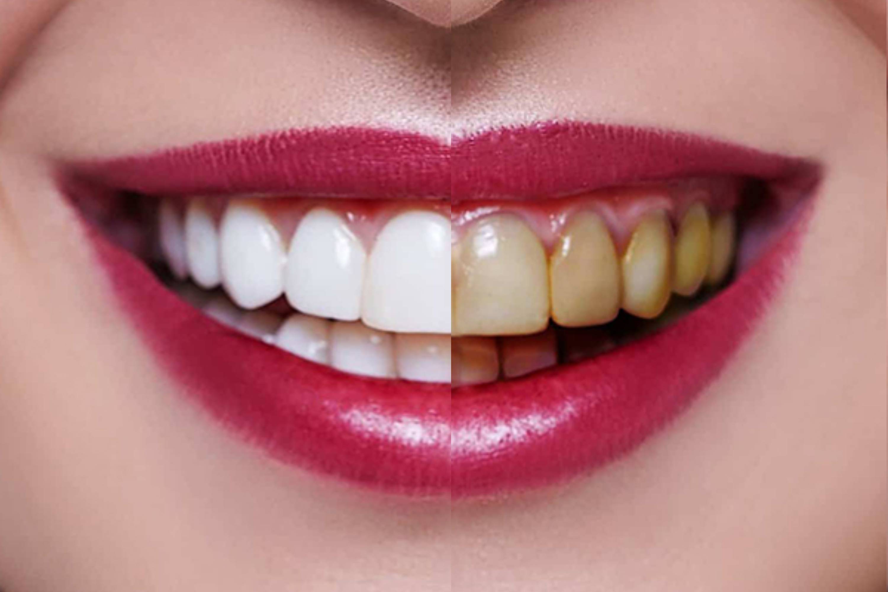 Whitening Teeth and Eyes in USA